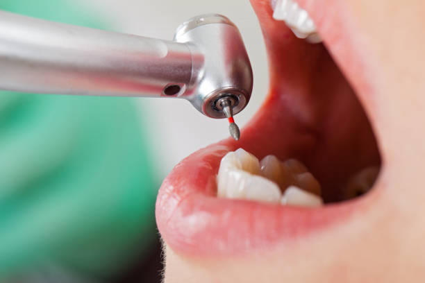 Best Emergency Root Canal Therapy in Maroa, IL